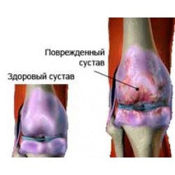 Глюкозамин и Хондроитин